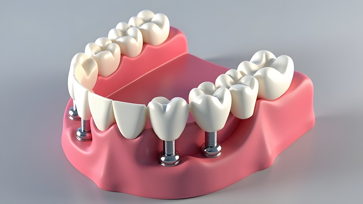 Revive Dental Co. | All on 4