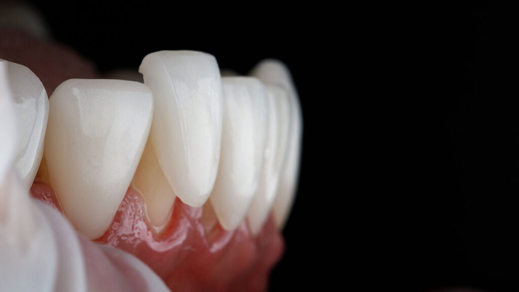 Revive Dental Co. | Porcelain Veneers in Oak Brook, IL: What to Know Before Transforming Your Smile Revive Dental Co. | Porcelain Veneers in Oak Brook, IL: What to Know Before Transforming Your Smile