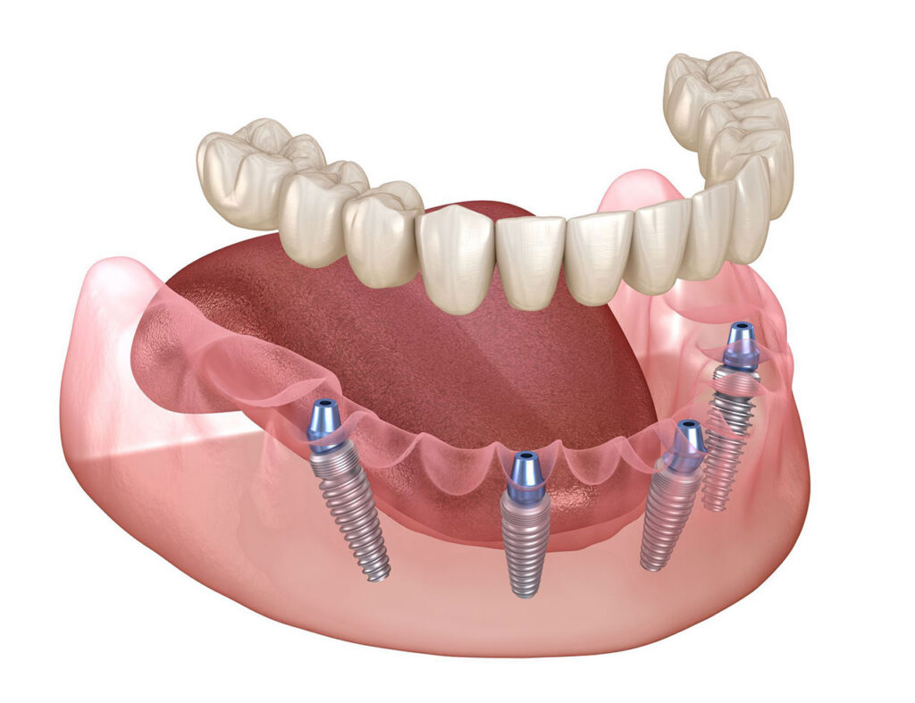 Revive Dental Co. | All-on-4 Implants in Oak Brook, IL: A Full-Smile Solution for Missing Teeth