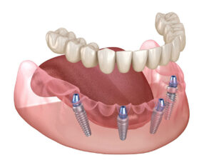 Revive Dental Co. | All-on-4 Implants in Oak Brook, IL: A Full-Smile Solution for Missing Teeth Revive Dental Co. | All-on-4 Implants in Oak Brook, IL: A Full-Smile Solution for Missing Teeth